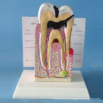 Modelo de Anatomia dos Dentes Patológicos Humanos para Demonstração